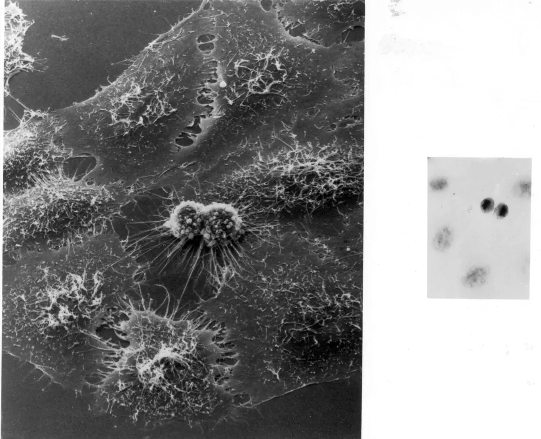 Black and white electron micrograph of HeLa cells infected with adenovirus, showing dense clusters of viral particles inside the cells.